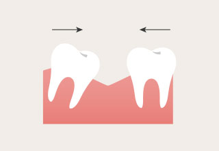 次第に周囲の歯が移動してきて、右側では噛めなくなります。