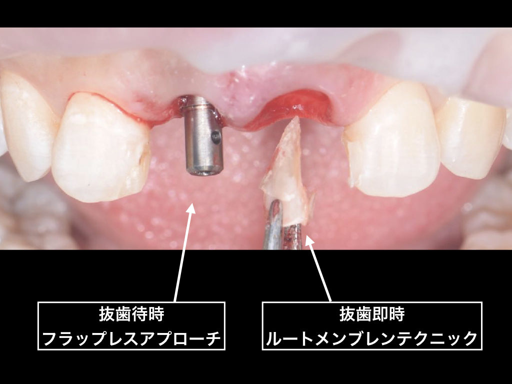 事故で前歯を失った方への早期治療【前歯部審美症例１】