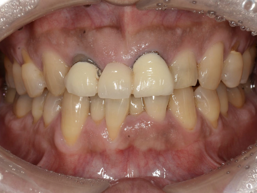 見た目の悪いブリッジをインプラントで改善【前歯部審美症例２】