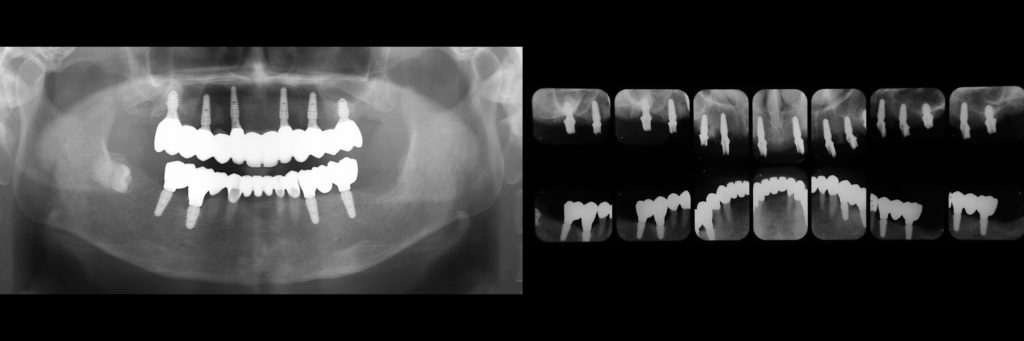 噛めないお口を歯ぐきを切らないインプラントで短期間に治療！【国際シンポジウムでの講演症例】