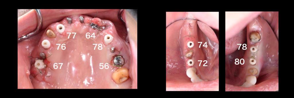 噛めないお口を歯ぐきを切らないインプラントで短期間に治療！【国際シンポジウムでの講演症例】