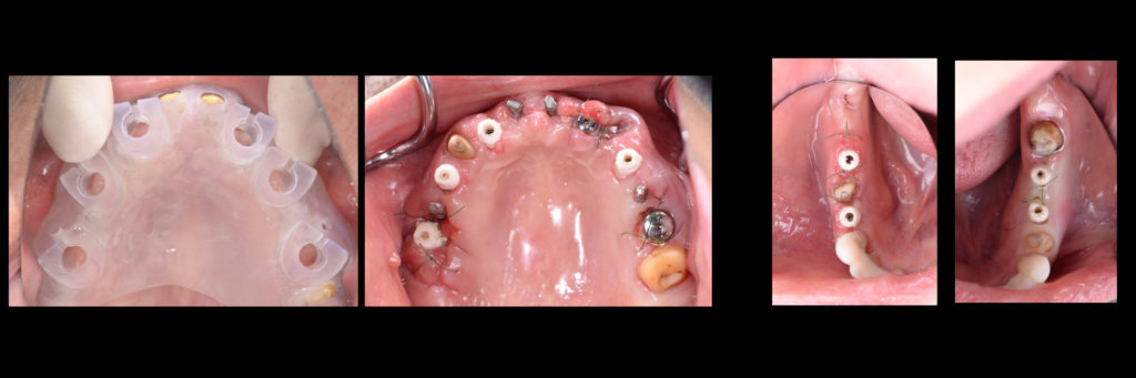 噛めないお口を歯ぐきを切らないインプラントで短期間に治療！【国際シンポジウムでの講演症例】