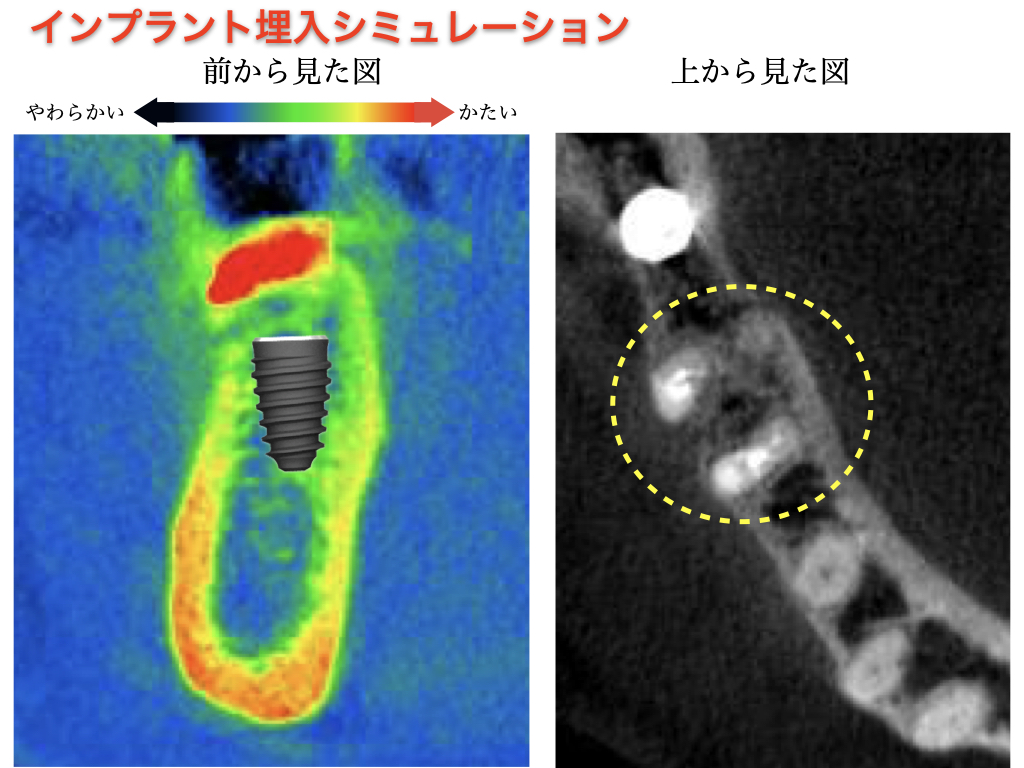 【骨がやわらかい方へのインプラント治療】