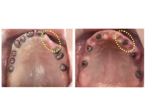 【インプラントのトラブルを解決した症例】