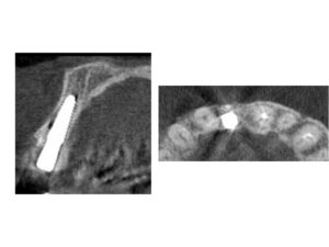 前歯が折れた後のインプラント治療【前歯部審美症例３】