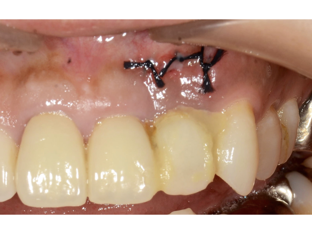 歯根端切除術後のインプラント治療【前歯部審美症例５】