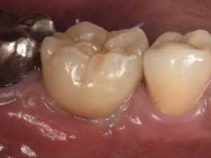 最新の機械（光学印象）でインプラントの補綴物を作った症例