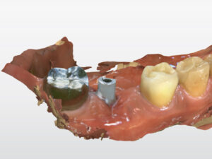 最新の機械（光学印象）でインプラントの補綴物を作った症例