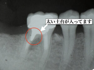 太い土台が原因で根っこが割れて治療した症例