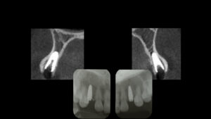 乳歯の晩期残存歯をインプラントで再建した症例【前歯部審美症例７】