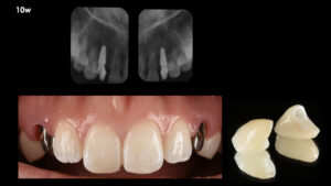 乳歯の晩期残存歯をインプラントで再建した症例【前歯部審美症例７】