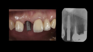 折れた前歯のインプラント治療【前歯部審美症例８】