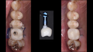 根が折れて骨が薄くなった奥歯をインプラント治療した症例