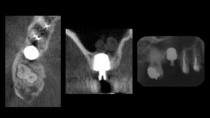 根が折れて骨が薄くなった奥歯をインプラント治療した症例