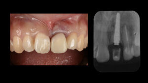 土台ごと折れた前歯をインプラントで治療した症例【前歯部審美症例12】