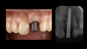 土台ごと折れた前歯をインプラントで治療した症例【前歯部審美症例12】
