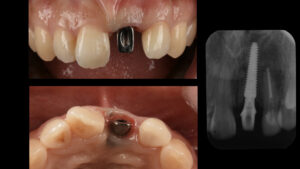 土台ごと折れた前歯をインプラントで治療した症例【前歯部審美症例12】