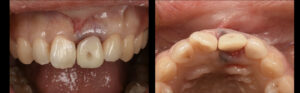 土台ごと折れた前歯をインプラントで治療した症例【前歯部審美症例12】