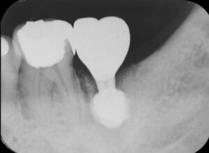 根の虫歯で抜歯になった下顎の奥歯をインプラントで再建した症例