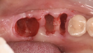 根の虫歯で抜歯になった下顎の奥歯をインプラントで再建した症例2