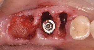 根の虫歯で抜歯になった下顎の奥歯をインプラントで再建した症例2