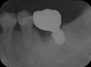 根の虫歯で抜歯になった下顎の奥歯をインプラントで再建した症例2