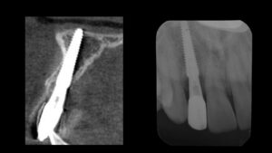 根が折れてしまった前歯をインプラントで治療した症例【前歯部審美症例10】