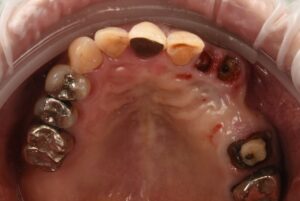 大きな虫歯と根の破折で抜歯適応となった歯を複数本インプラントで再建した症例