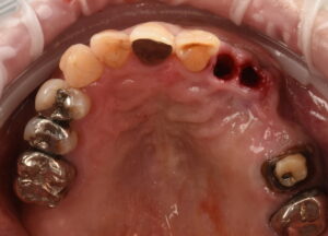 大きな虫歯と根の破折で抜歯適応となった歯を複数本インプラントで再建した症例
