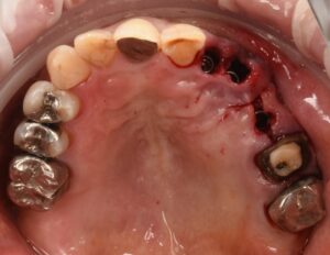 大きな虫歯と根の破折で抜歯適応となった歯を複数本インプラントで再建した症例