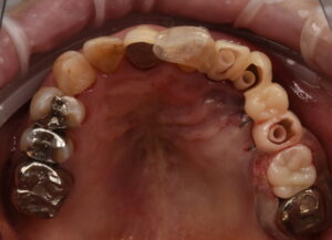 大きな虫歯と根の破折で抜歯適応となった歯を複数本インプラントで再建した症例