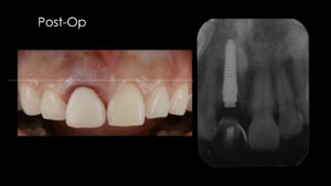 ぶつけて折れてしまった歯をインプラントで治療した症例【前歯部審美症例15】