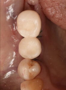 奥歯にインプラントを入れてしっかり噛めるようになった症例