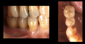奥歯にインプラントを入れてしっかり噛めるようになった症例