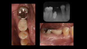 根が折れて骨が吸収した奥歯をインプラントで治療した症例