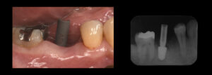 根が折れて骨が吸収した奥歯をインプラントで治療した症例
