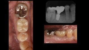 根が折れて骨が吸収した奥歯をインプラントで治療した症例