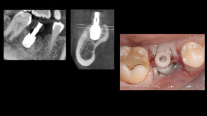 根が折れた奥歯をインプラントで治療した症例