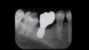 根が折れた奥歯をインプラントで治療した症例