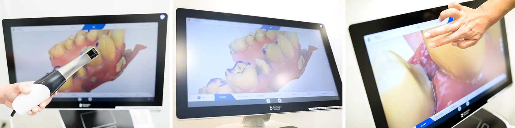 精密な歯並びデータを採取するプライムスキャン（口腔内スキャナ）
