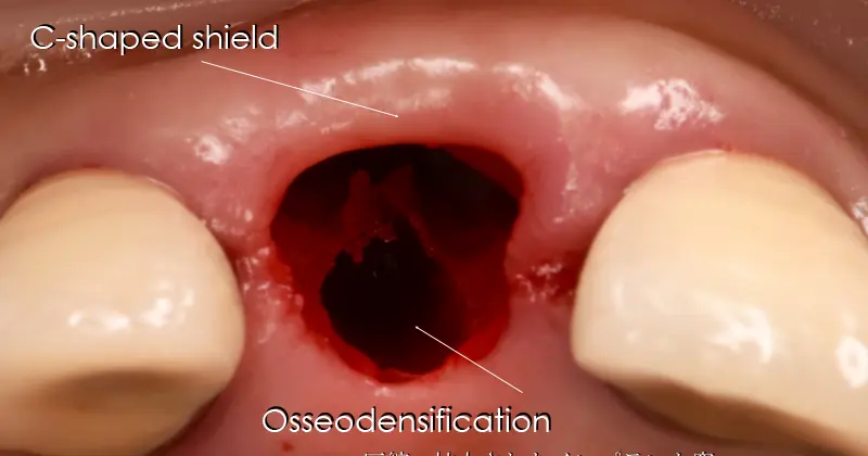 抜歯して、インプラント埋入のスペースを形成します。