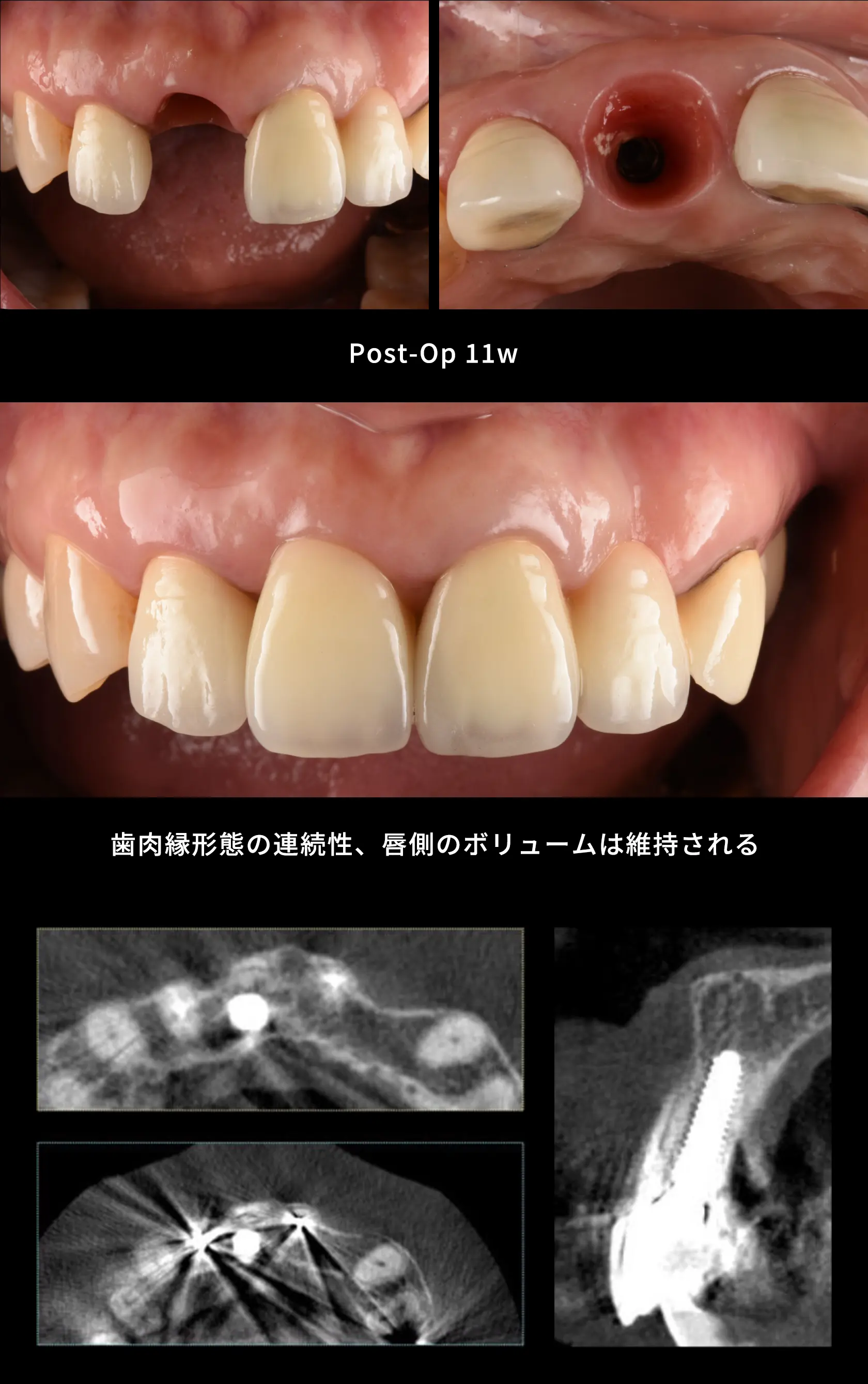 オペ10週後に、セラミックの本番の歯をセットしました。仮歯の状態と比較すると、その違いは一目瞭然。歯の色はもちろん、際のラインが整っているのがわかります。一目見ただけでは、どの歯がインプラントなのか、なかなか見分けることができません。なかやま歯科のインプラント治療は、このようなプロセスを経て治療を終了します。