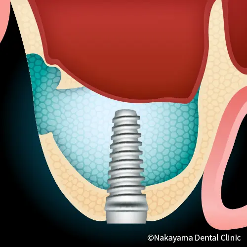第1世代「サイナスリフトによるインプラント治療」