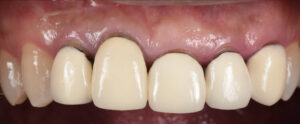 前歯複数本をインプラントで再建した症例【前歯部審美症例９ 