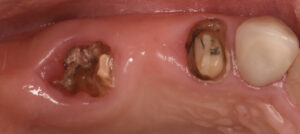 根の虫歯で抜歯になった上顎の奥歯をインプラントで再建した症例