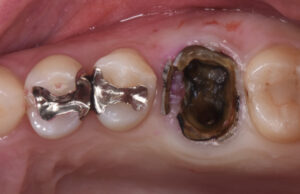 根が折れてしまった上顎の奥歯をインプラントで治療した症例
